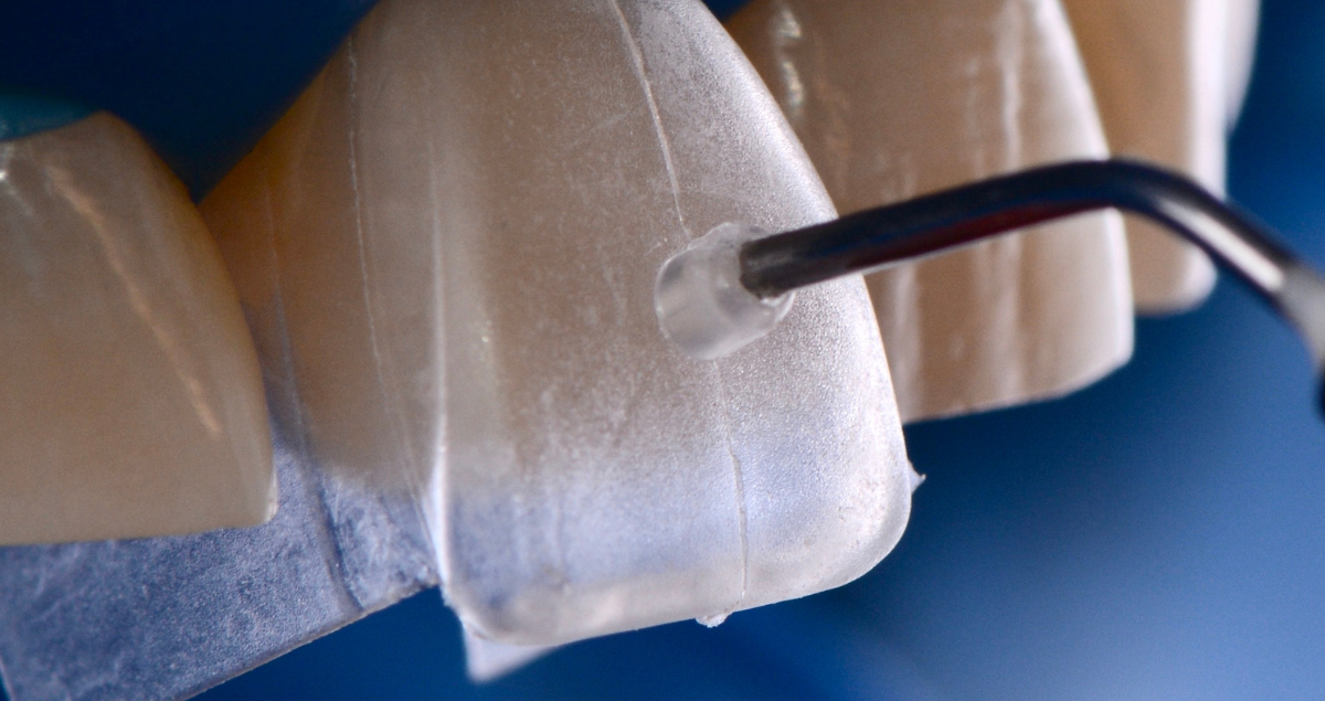 Flow Injection per faccette in composito
